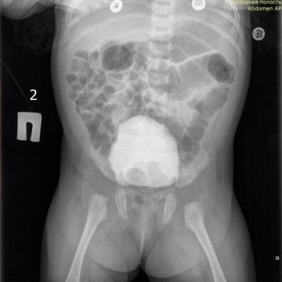 Особенности CAKUT-синдрома: клинический случай.